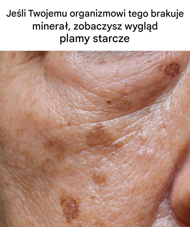 Niedobór tego minerału zwiększa ryzyko pojawienia się plam starczych.