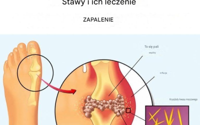 Jak usunąć kwas moczowy i leczyć zapalenie stawów