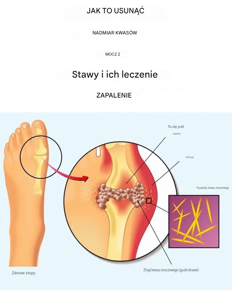 Jak usunąć kwas moczowy i leczyć zapalenie stawów